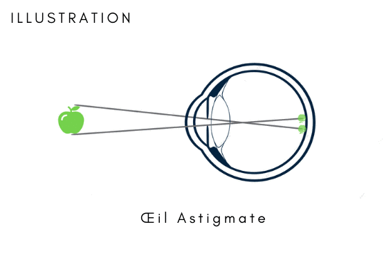 schema oeil astigmate animation