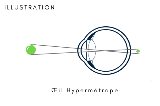 schema oeil hypermetrope animation