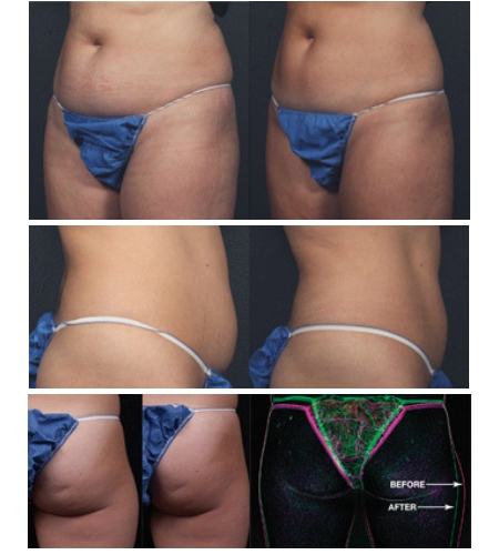 Remodelage cellulite ventre et fesses avant apres remodelage ventre et fesses